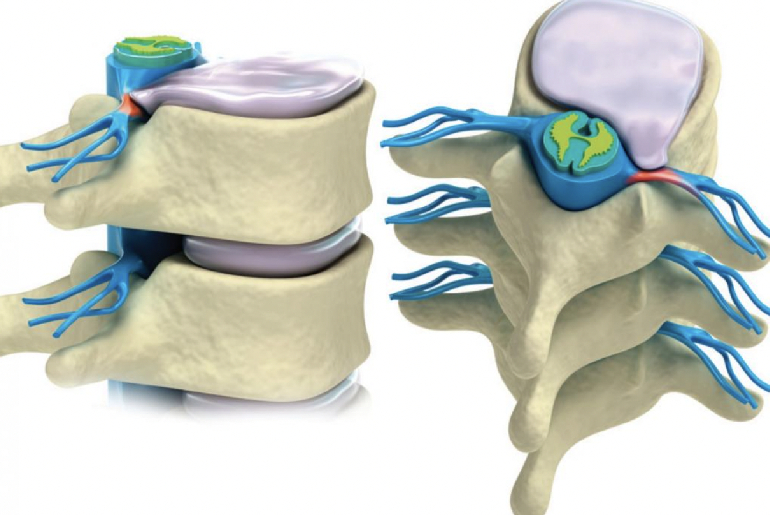 Enfermedad degenerativa del disco intervertebral