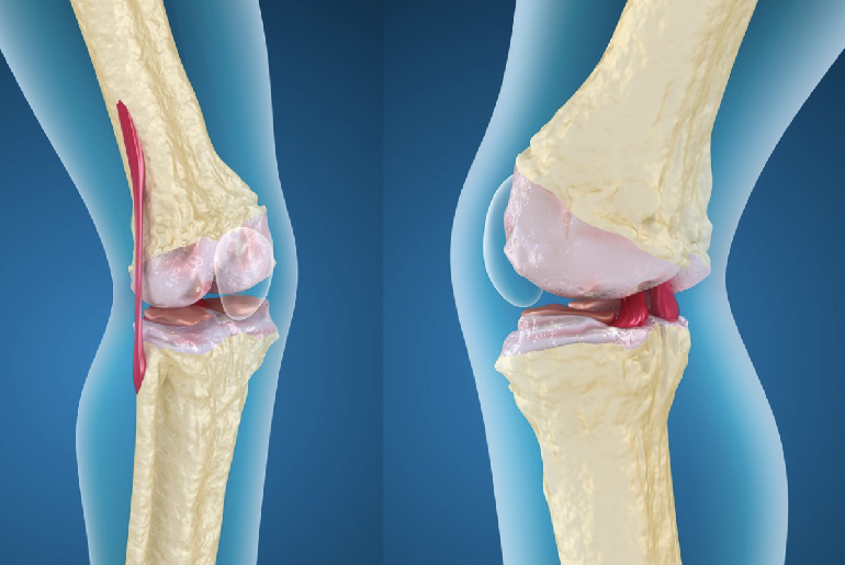 Enfermedad degenerativa de la rodilla