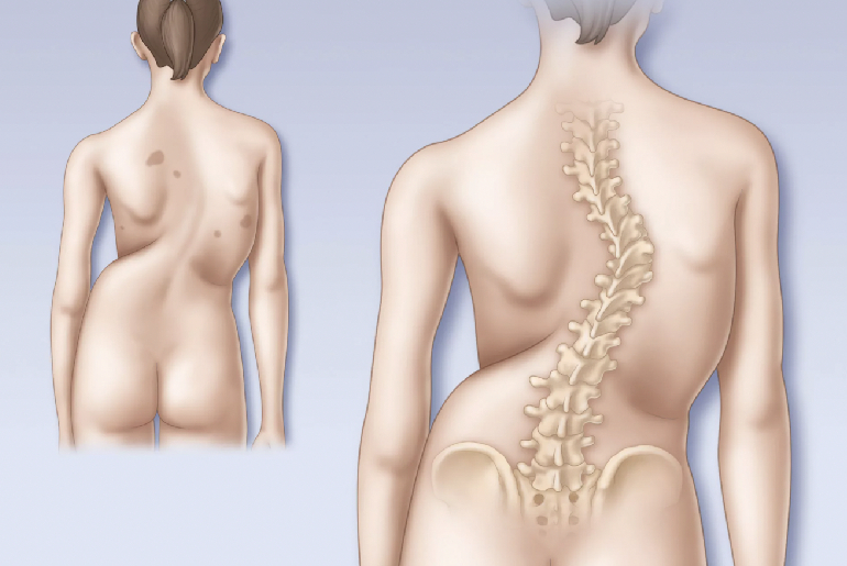 Escoliosis torácica y lumbar degenerativa