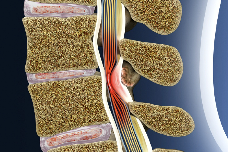 Estenosis lumbar y espondilolistesis