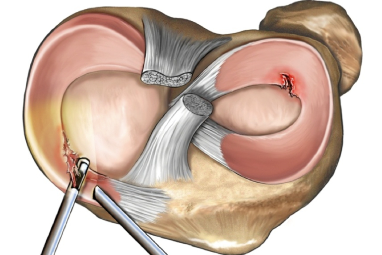 Lesiones meniscales